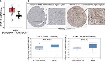 EVA1C Is a Potential Prognostic Biomarker and Correlated With Immune Infiltration Levels in WHO Grade II/III Glioma